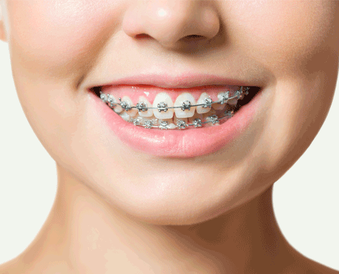Early Orthodontic Treatment
