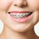 Early Orthodontic Treatment